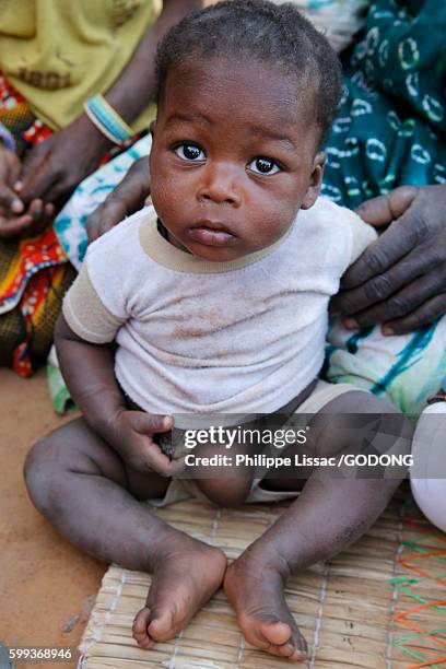 peul child with elephantiasis. - elephantiasis stockfoto's en -beelden