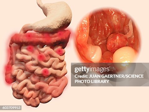 Intestinal polyps, illustration Intestinal polyps, illustration