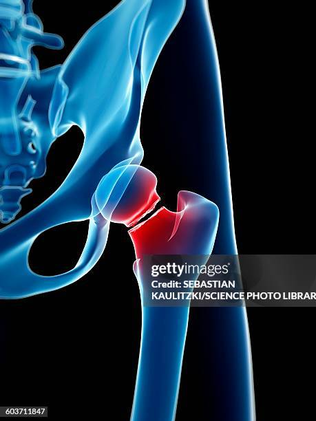 broken hip bone, illustration - femur stock illustrations