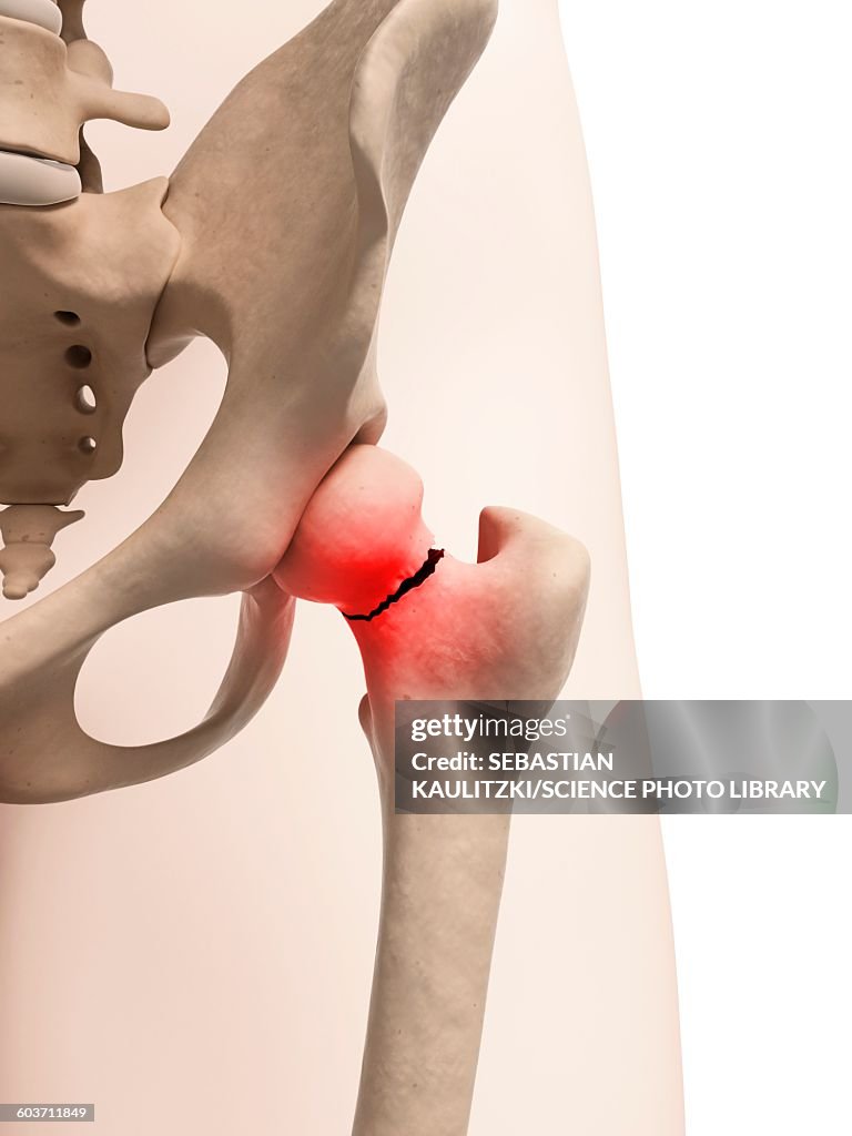 Broken hip bone, Illustration