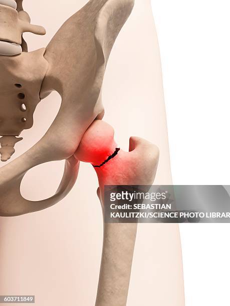 broken hip bone, illustration - femur stock-grafiken, -clipart, -cartoons und -symbole