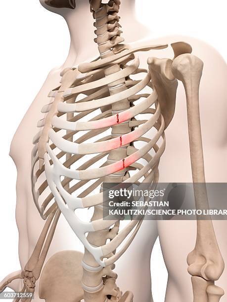 broken ribs, illustration - rib cage stock-grafiken, -clipart, -cartoons und -symbole