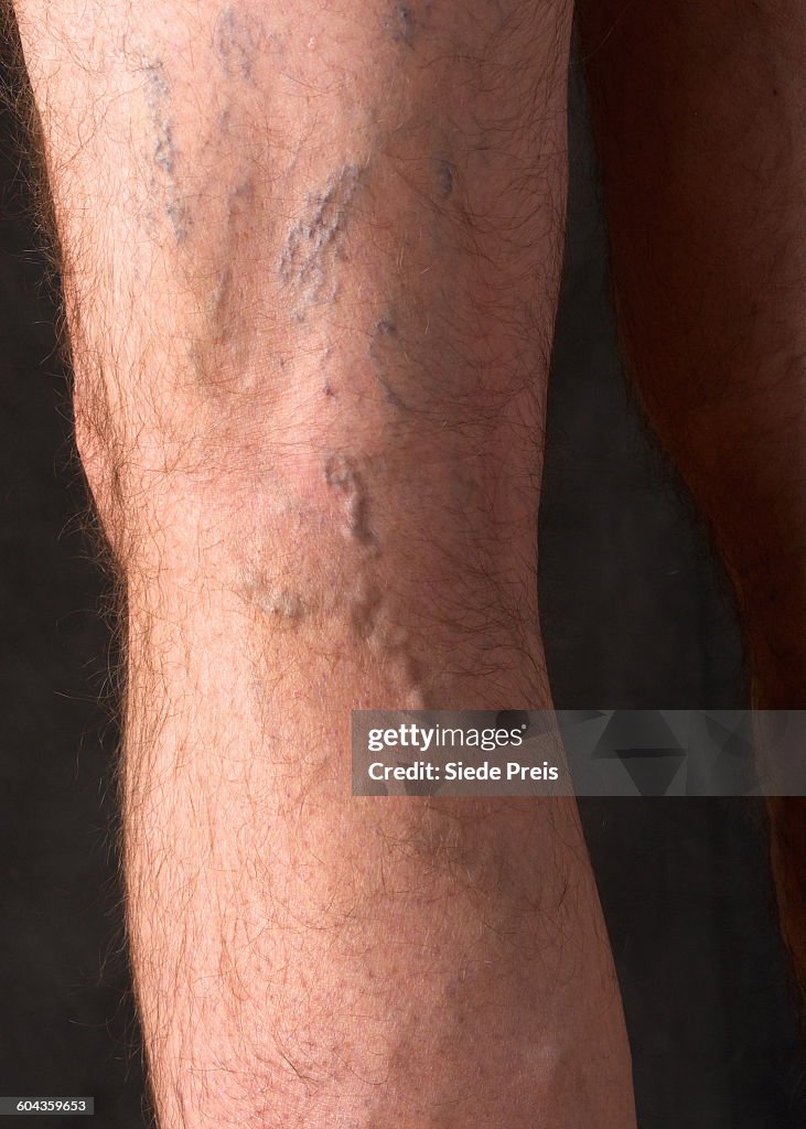 Varicose veins on a man's leg