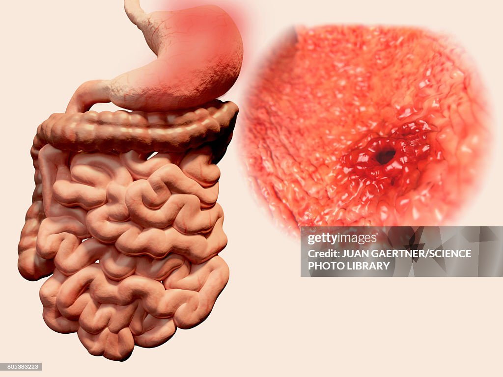 Gastric ulcer, illustration