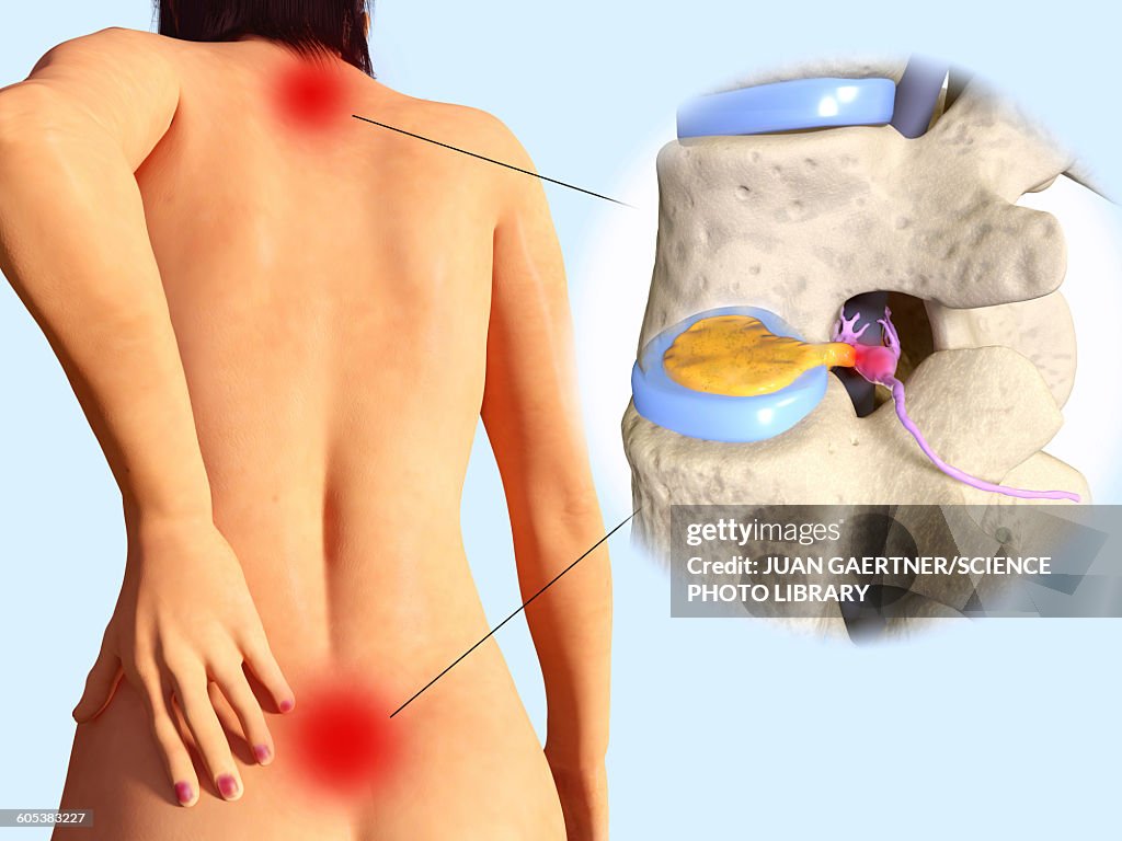 Slipped disc, illustration