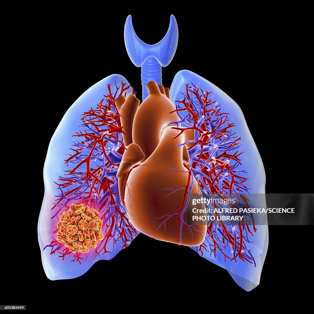 Pulmonary embolism, artwork
