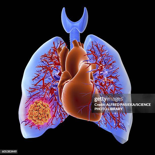 pulmonary embolism, artwork - alfred stock illustrations