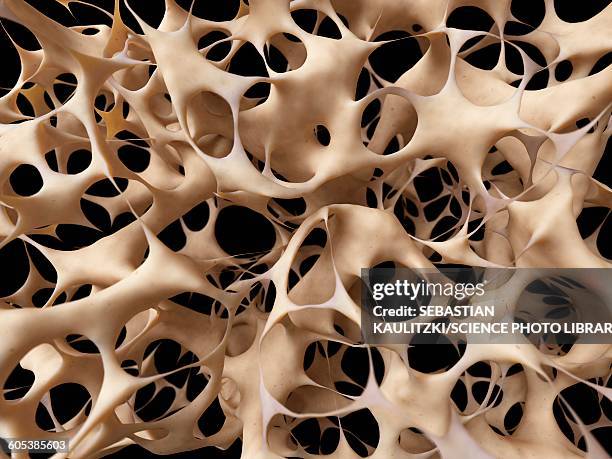 bones with osteoporosis, illustration - osteoporose stock-grafiken, -clipart, -cartoons und -symbole