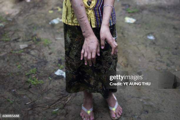 San Kay Khine, a 17-year-old Myanmar child slave, shows her scarred arms and twisted fingers while recovering in her family's village in Baw Lone...