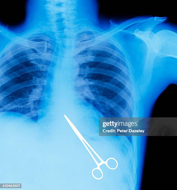 retained surgical instrument - mistake stockfoto's en -beelden