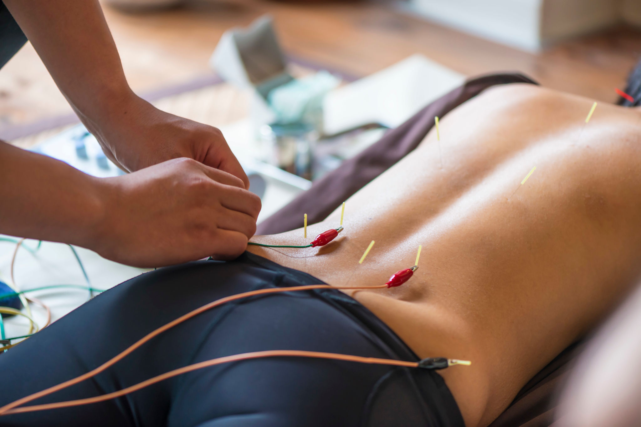 Young woman at the acupuncture treatment Young woman at the acupuncture treatment