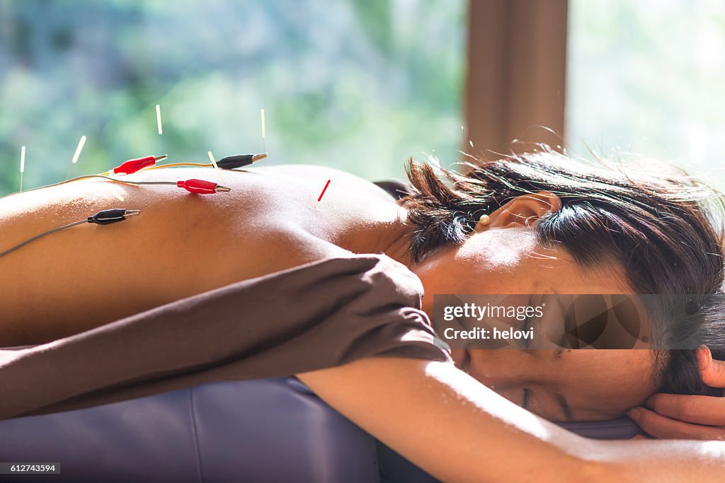 Young woman at the acupuncture treatment