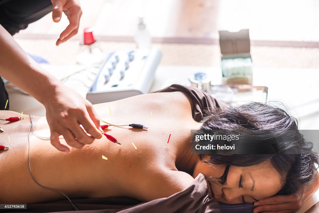 Young woman at the acupuncture treatment