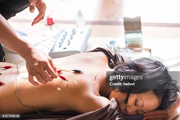 young woman at the acupuncture treatment - acupuncture stock pictures, royalty-free photos & images