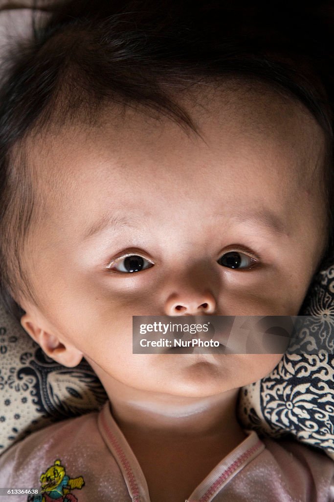 Hydrocephalus diagnose in Indonesia