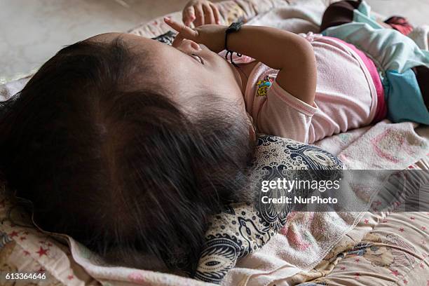 Month-old NARA ARISKA who suffers from a rare condition called hydrocephalus - known as water on the brain - sleeps at a hut in Toboali village on...