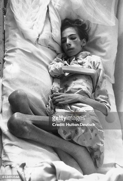 Concentration camp victim Vera Berger, aged 13, suffering from starvation, typhus and tuberculosis lies in a hospital bed at Ravensburgh Camp. 1945.