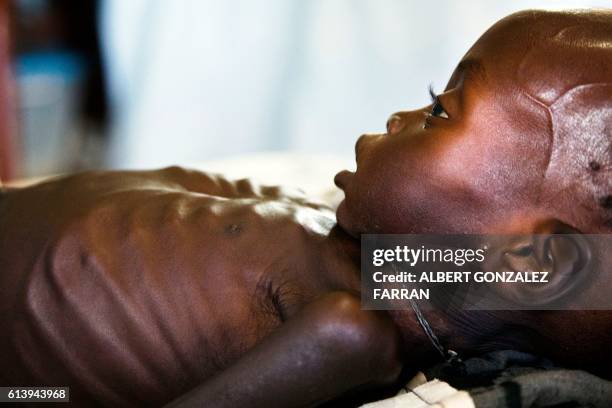 Agop Manut , who suffers acute malnutrition and respiratory distress, is assisted at the clinic run by Doctors without Borders in Aweil, Northern...