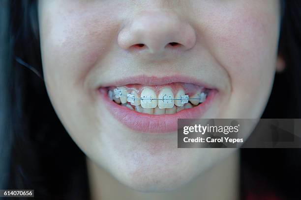 girl in white braces - extreme close up mouth stock pictures, royalty-free photos & images