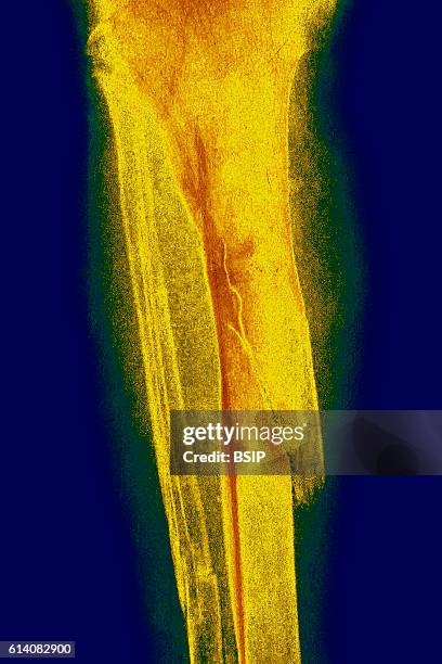 Fractures of the tibia and fibula seen on a frontal x-ray.