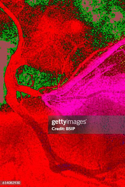 Myocardial infarction caused by a stenosis of the right coronary artery. Seen via coronarography.