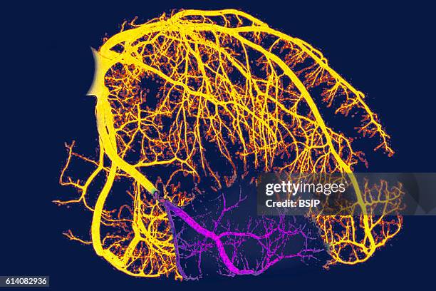 Myocardial infarction caused by a stenosis of the right coronary artery. Illustration.