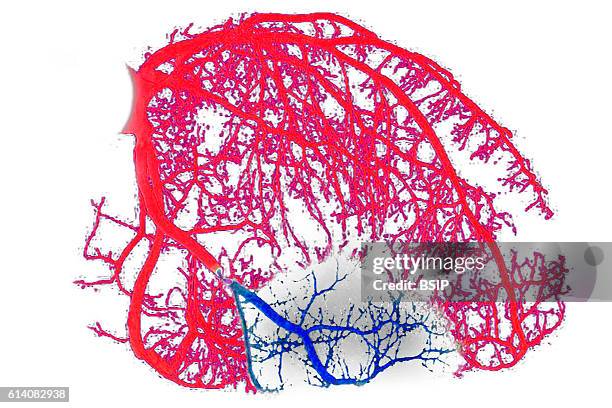 Myocardial infarction caused by a stenosis of the right coronary artery. Illustration.