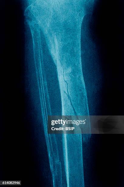 Fractures of the tibia and fibula seen on a frontal x-ray.