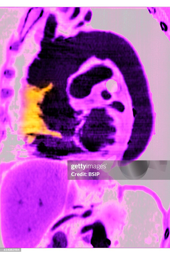 Aortic dissection, mri