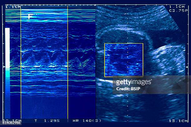 Doppler ultrasound scan of a foetus in the fifth month of pregnancy.