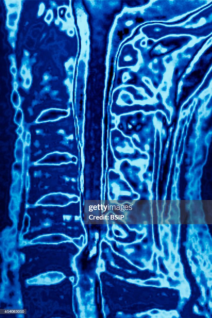 Herniated disk, mri