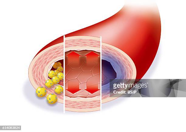 Illustration of risk factors facilitating the formation of an atheromatous plaque, dyslipidemia, high arterial blood pressue, smoking related hypoxia.