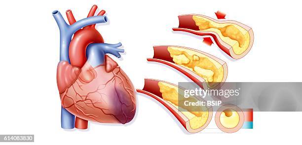 Illustration of the causes of a myocardial infarction, necrosis of part of the secondary heart muscle through an oxygenation flaw . The infarction...