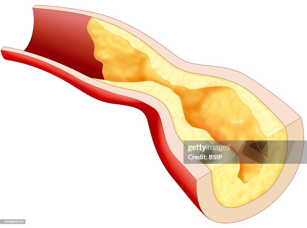Atheroma, drawing