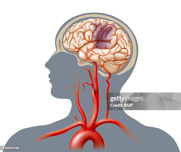 Illustration of a cerebrovascular accident caused by an occlusion in the carotid.