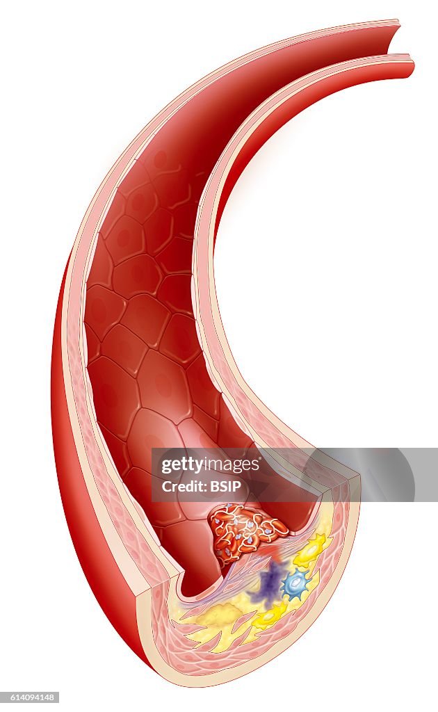 Atheroma, drawing