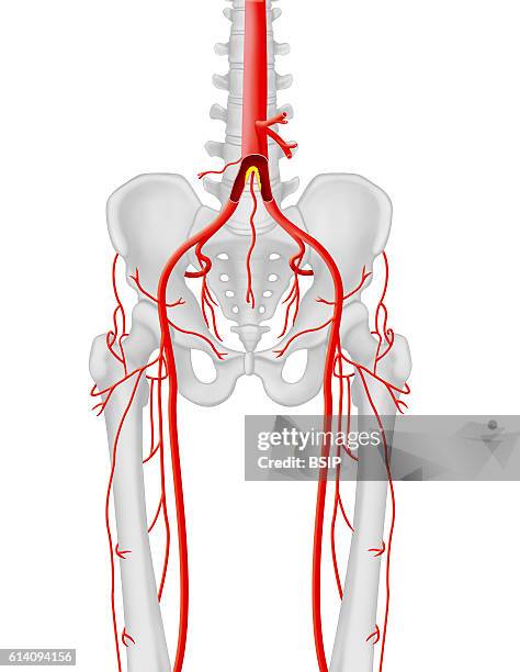 Frontal anatomical illustration of the location of the stenosis or occlusion at the aortic bifurcation, lower limb arterial axis.