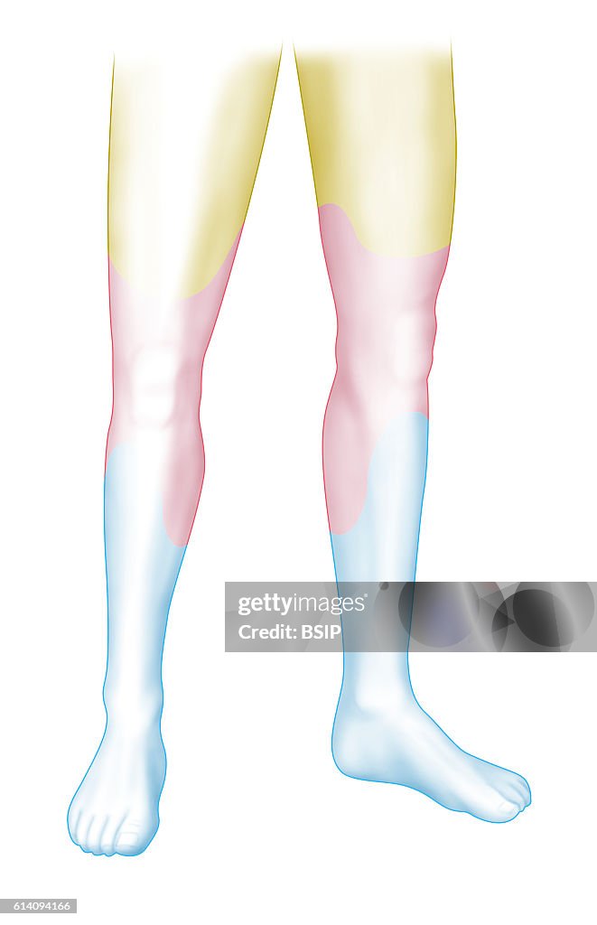 Arterial stenosis