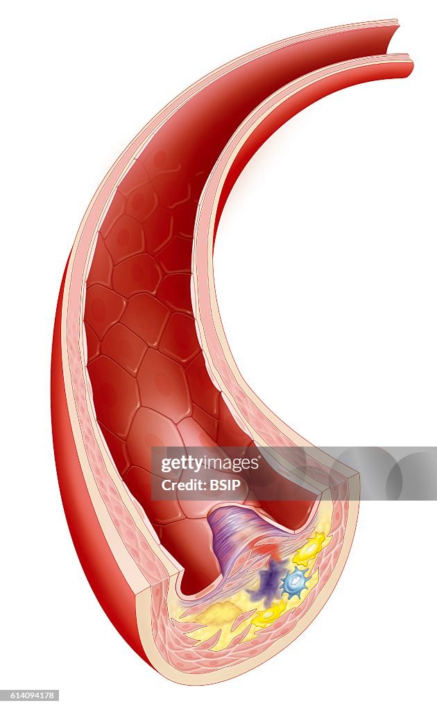 Atheroma, drawing