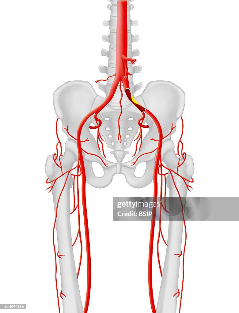 Arterial stenosis