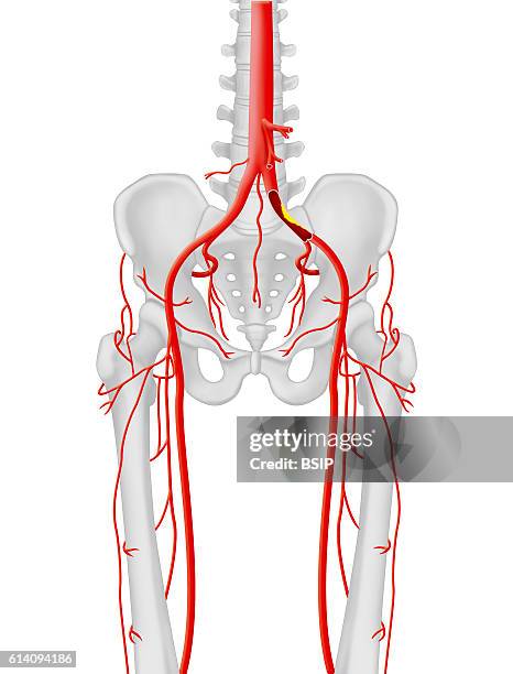 Frontal anatomical illustration of the location of the stenosis or occlusion at the left common iliac artery, lower limb arterial axis.