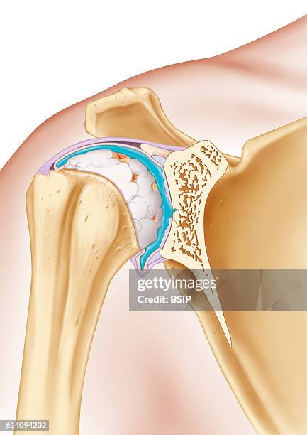 Illustration of the treatment of osteoarthritis in the shoulder, by injecting a viscosupplement into the synovial joint surrounded by its membrane ....