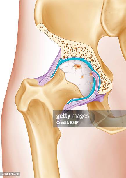 Illustration of the treatment of osteoarthritis in the hip, by injecting a viscosupplement into the synovial joint surrounded by its membrane . This...