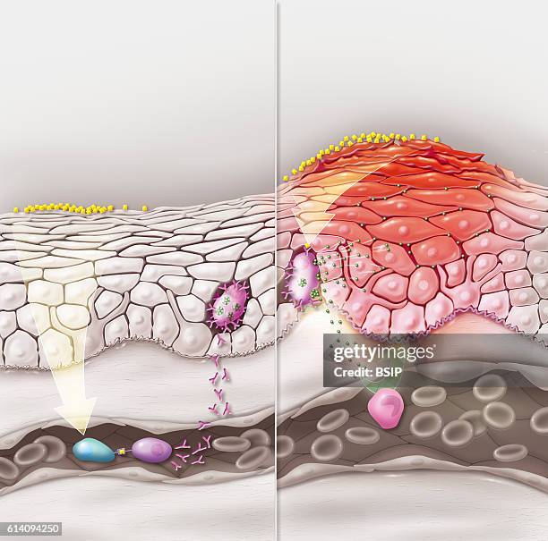 Illustration of a skin contact allergy, at first contact, the reaction phase and second contact, the allergic reaction manifests itself. During the...