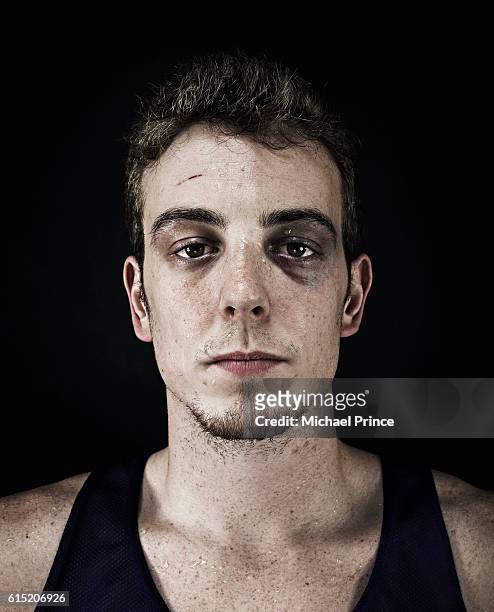 portrait of young man with bruise under eye - black eye stockfoto's en -beelden