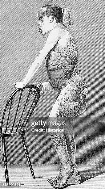 John Merrick, The Elephant Man, leans against a chair displaying the deformities caused by the disease Neurofibromatosis.