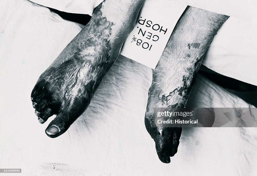 Gangrene Feet