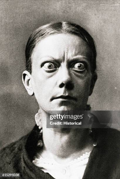 Patient with exophthalmic goiter caused by hyperthyroidism. Changes in the eyes take two forms: retraction of the eyelids and proptosis, or bulging....