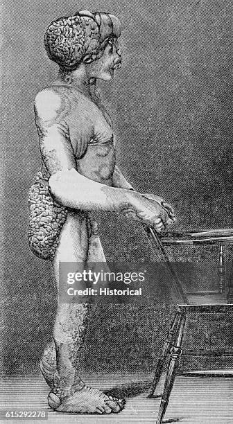 John Merrick, The Elephant Man, stands in right profile behind a chair to illustrate the deformities caused by his disease, Neurofibromatosis.