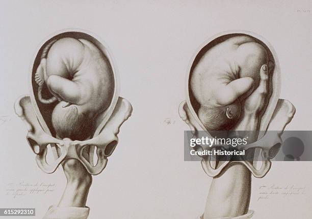 An anatomical diagram depicts the method of extracting a fetus by reaching into the uterus and adjusting the baby's position.